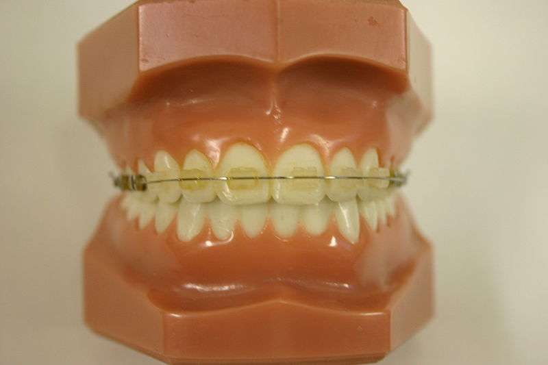 Transparent brackets on a scary, scary mold of human teeth. Photo: Wikipedia. 